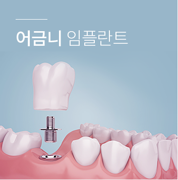 어금니 임플란트